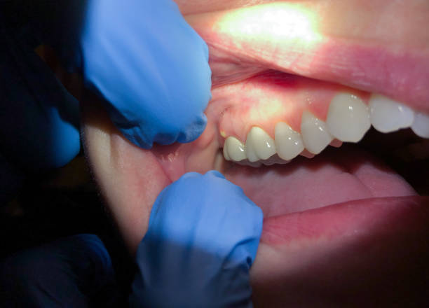 Best Emergency Dental Care for Sports Injuries in Gordonsville, VA